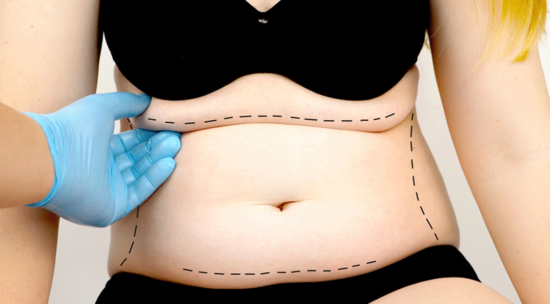 Um bom resultado na abdominoplastia depende da escolha do cirurgião plástico