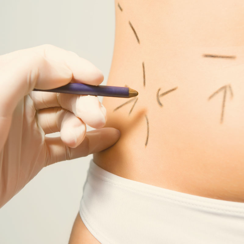 Quer fazer uma lipoaspiração? Saiba como escolher o cirurgião plástico